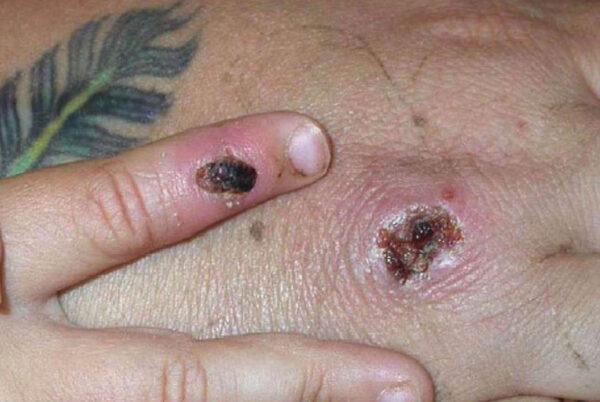 Symptoms of a case of the monkeypox virus are shown on a patient's hand on June 5, 2003. (CDC/Getty Images)