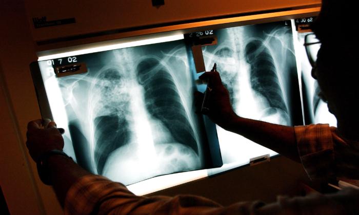 Emergency Declared on Tuberculosis in California City: What to Look For