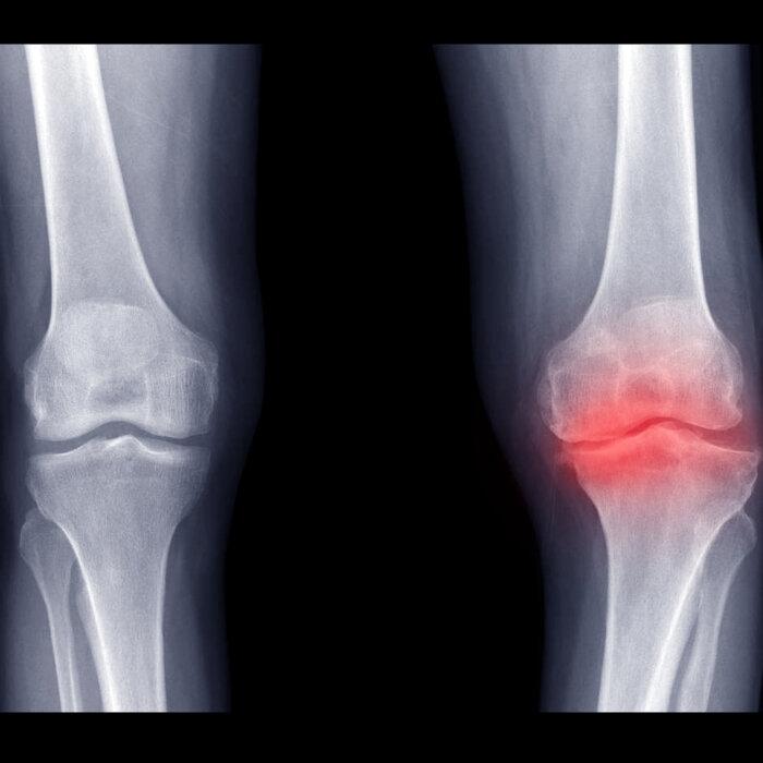 Pulsed Electromagnetic Field Therapy May Relieve Osteoarthritis: Study